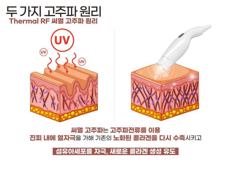 폴카 RF 피부관리 기기 프락셀 고주파 프락셔널 피부 관리기 프락셀 피부재생 콜라겐생성 리프팅 노화 눈가주름 - 한국