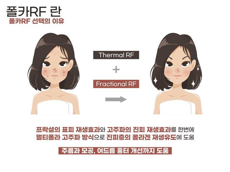 폴카 RF 피부관리 기기 프락셀 고주파 프락셔널 피부 관리기 프락셀 피부재생 콜라겐생성 리프팅 노화 눈가주름 - 한국