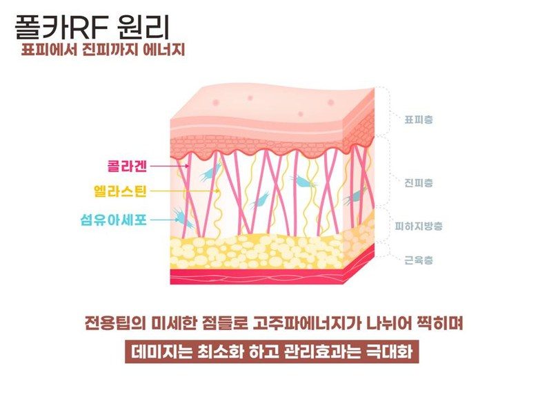 폴카 RF 피부관리 기기 프락셀 고주파 프락셔널 피부 관리기 프락셀 피부재생 콜라겐생성 리프팅 노화 눈가주름 - 한국