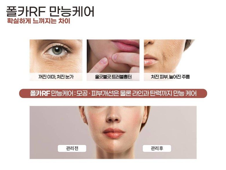 폴카 RF 피부관리 기기 프락셀 고주파 프락셔널 피부 관리기 프락셀 피부재생 콜라겐생성 리프팅 노화 눈가주름 - 한국